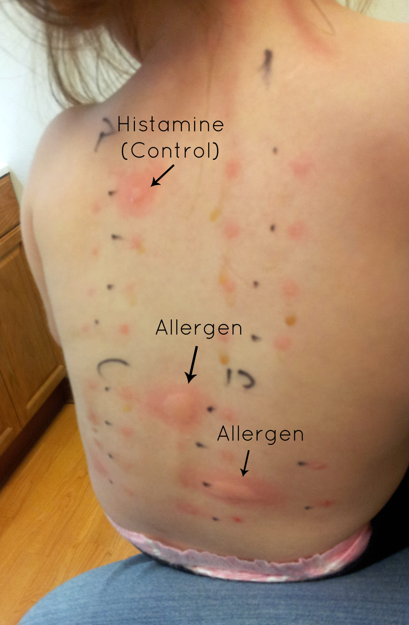 allergy-skin-test-results-chart-numbers