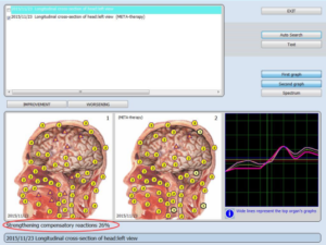 bioresonance for sleep apnea